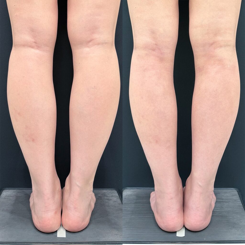 女性のふくらはぎ前後比較