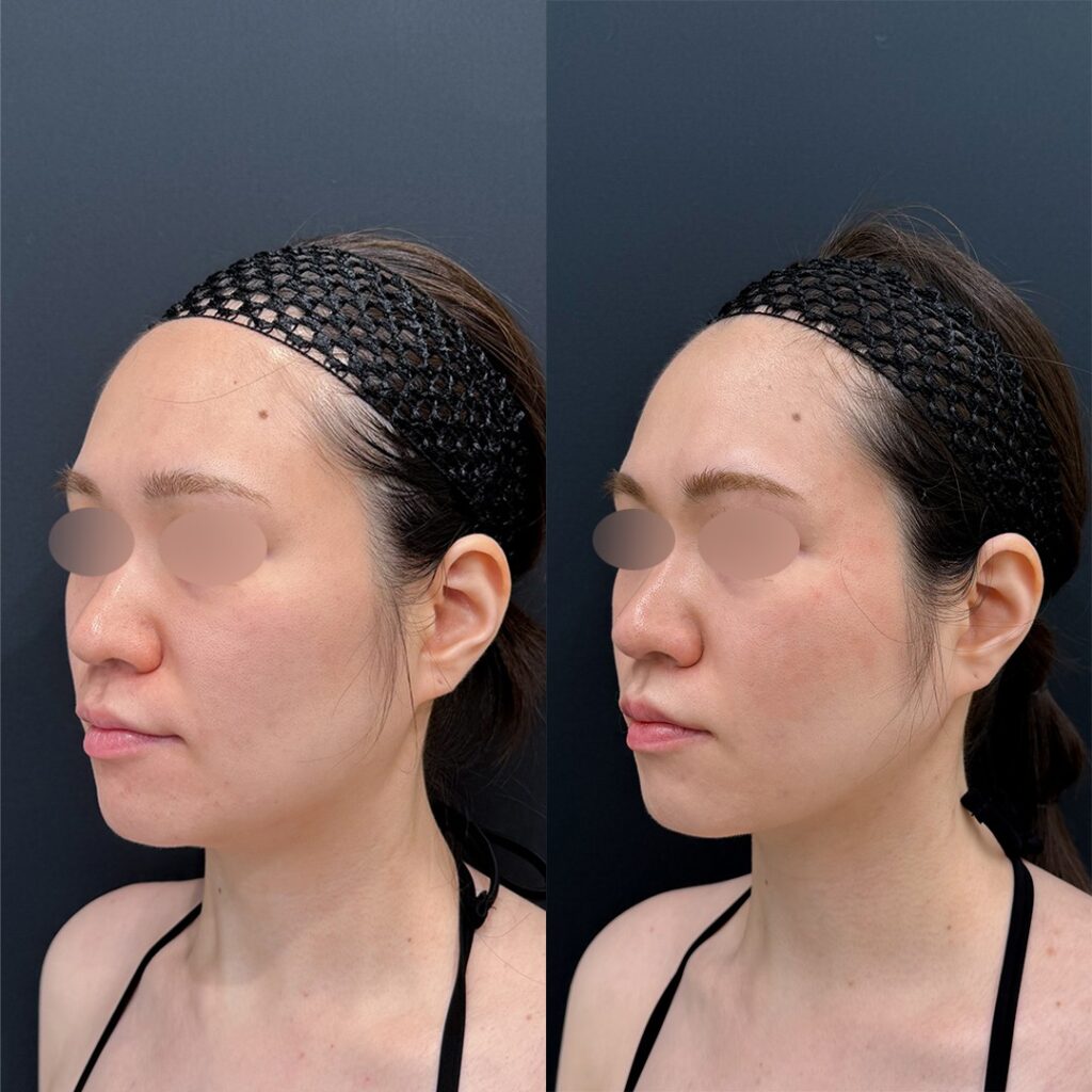 女性の顔のBeforeAfter比較