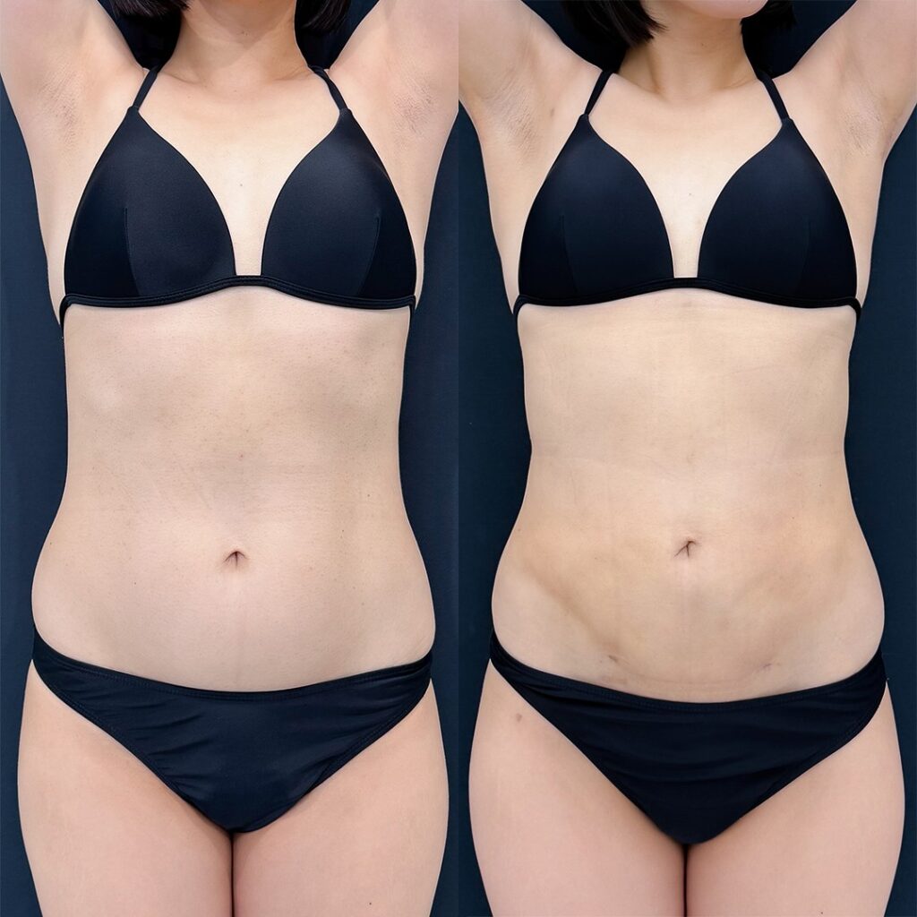 腹部脂肪吸引×エルサ（LSSA）×クォンタムRF｜術後の変化