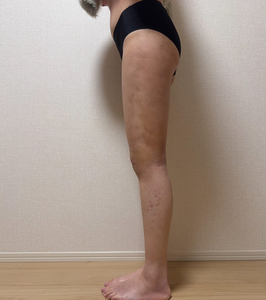 足の脂肪吸引