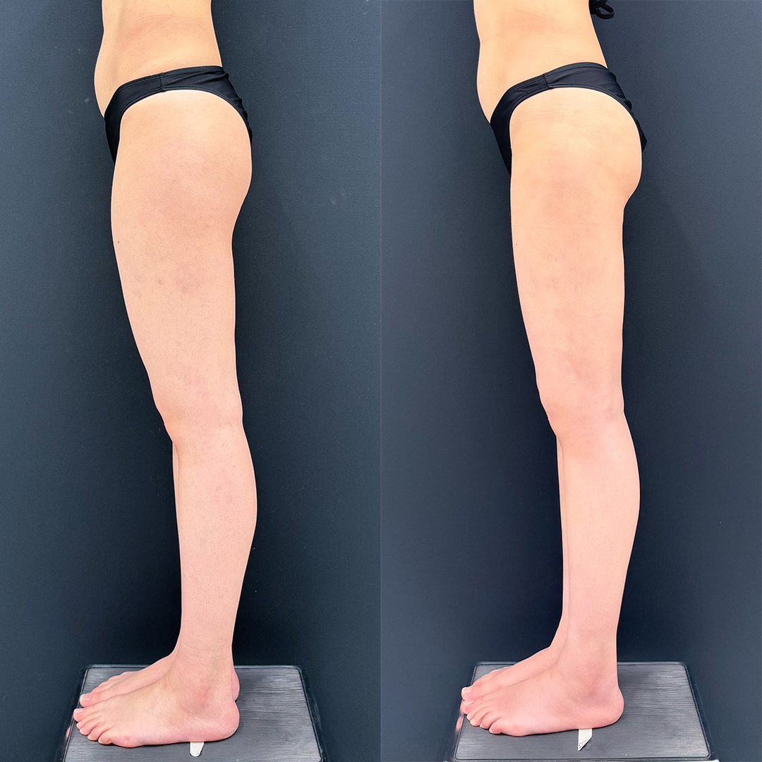 https://purelys-tokyo-clinic.com/wp/wp-content/uploads/2026/02/leg-Liposuction_Case-No.663.jpg