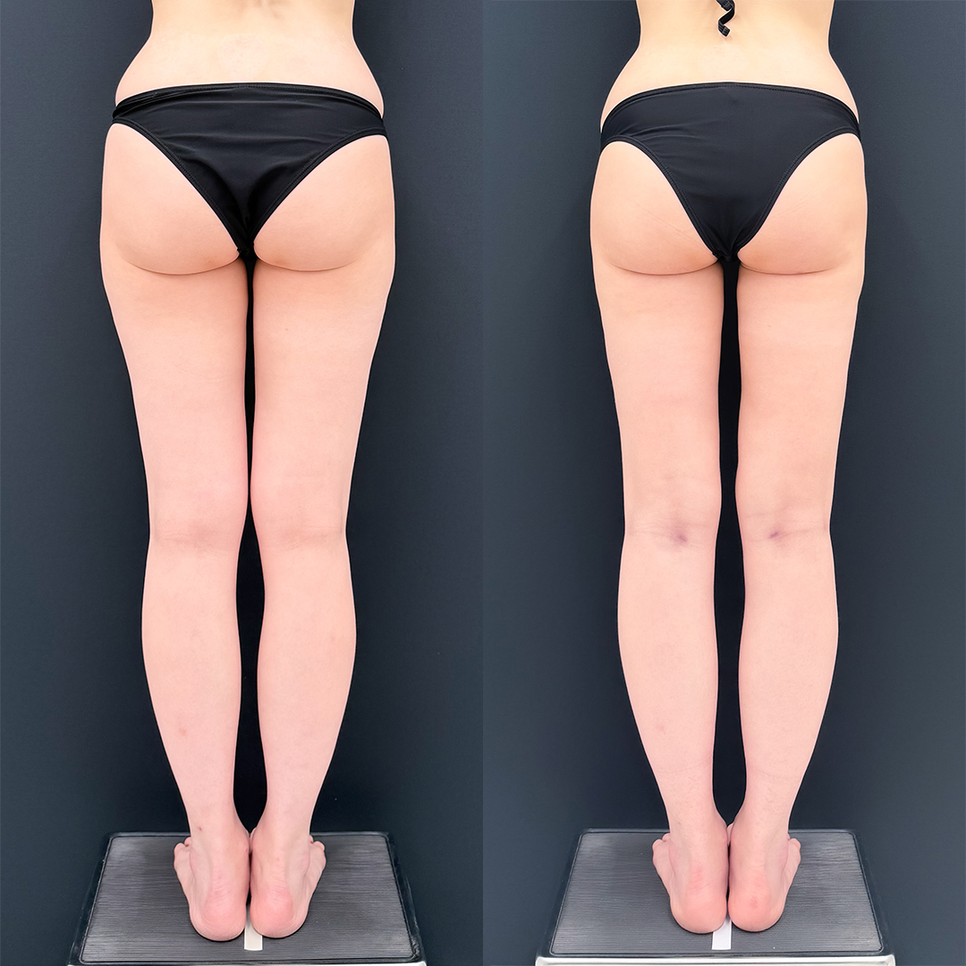 https://purelys-tokyo-clinic.com/wp/wp-content/uploads/2026/02/leg-Liposuction_Case-No.717.jpg