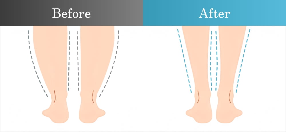 太めの足と改善された足の比較
