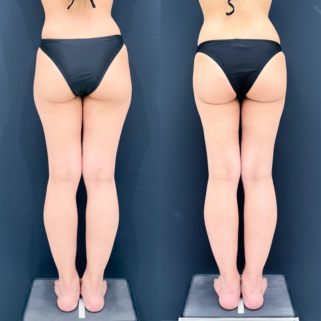 クォンタムRF(quantumRF) ・エルサ(LSSA) ・太もも脂肪吸引を使用した症例の背面