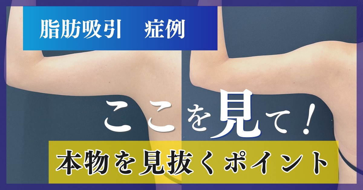 脂肪吸引の症例写真の見方、加工なしの本物を見抜くポイントと経過別の変化を専門医が解説