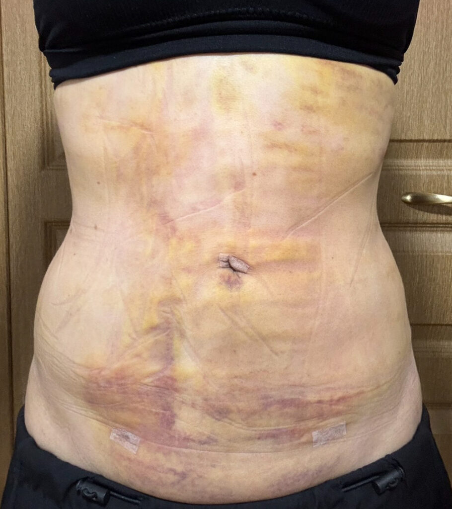 お腹の脂肪吸引