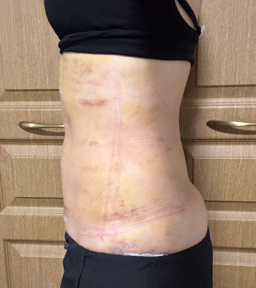 お腹の脂肪吸引