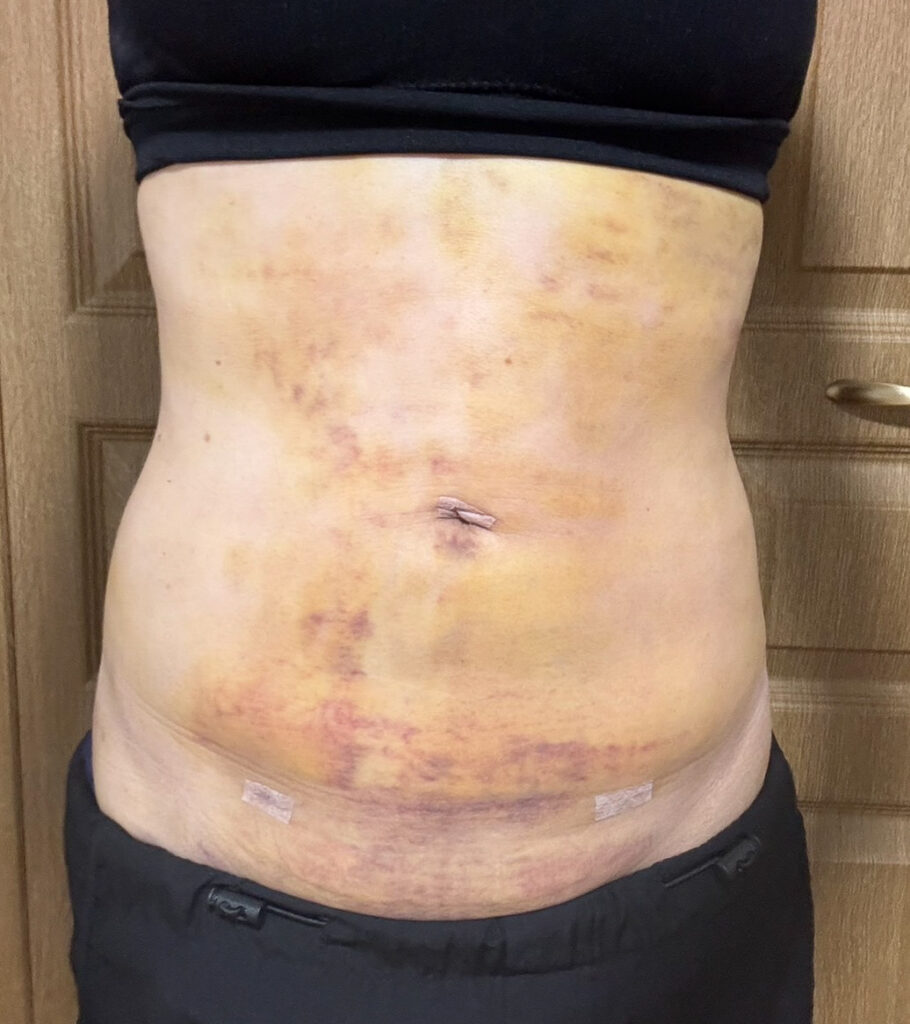 お腹の脂肪吸引