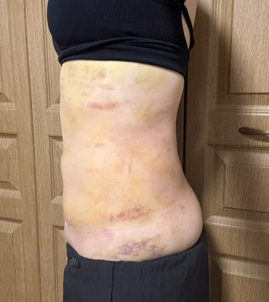 お腹の脂肪吸引