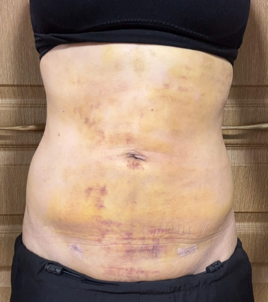 お腹の脂肪吸引