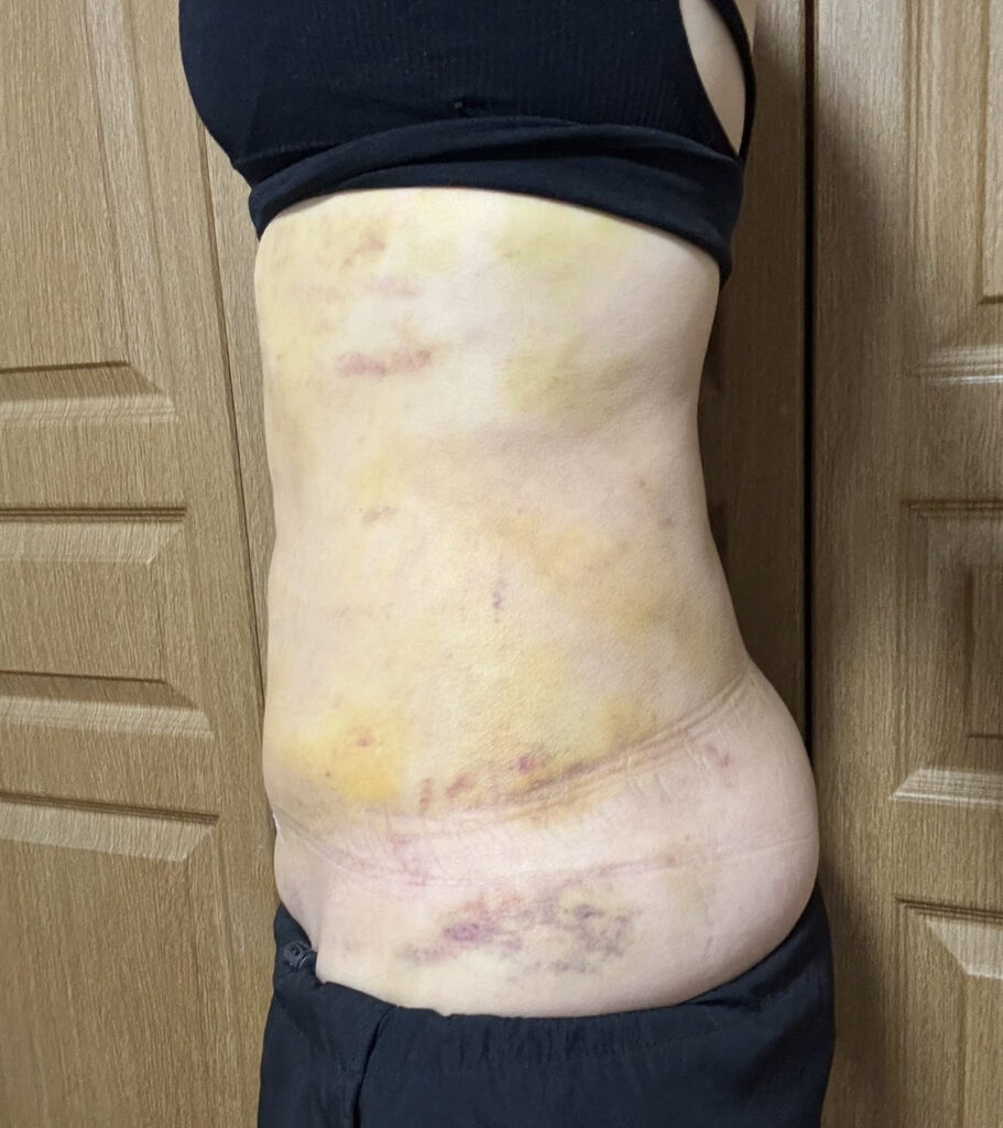 お腹の脂肪吸引