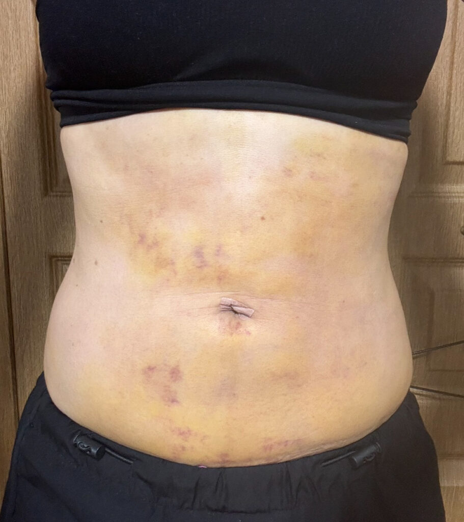 お腹の脂肪吸引