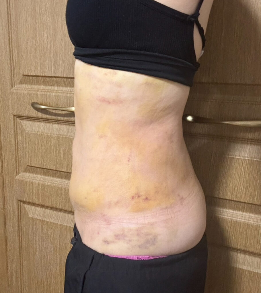 お腹の脂肪吸引