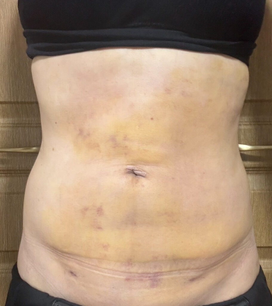 お腹の脂肪吸引