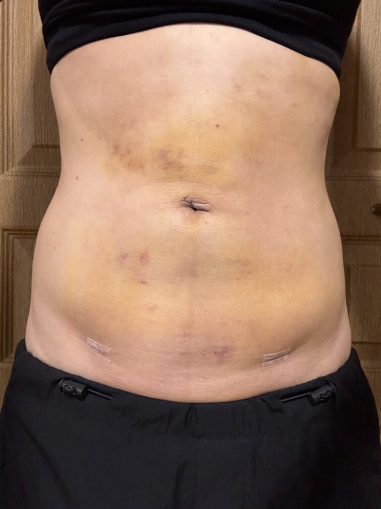 お腹の脂肪吸引