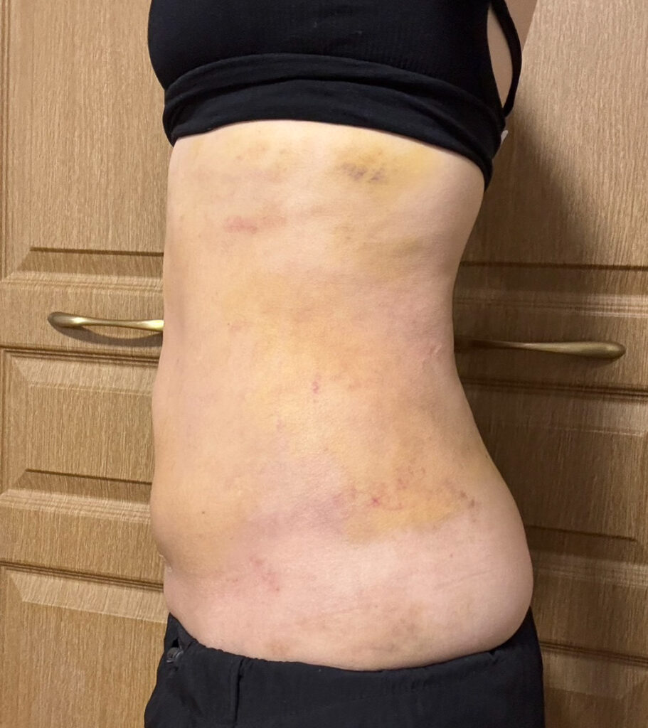 お腹の脂肪吸引