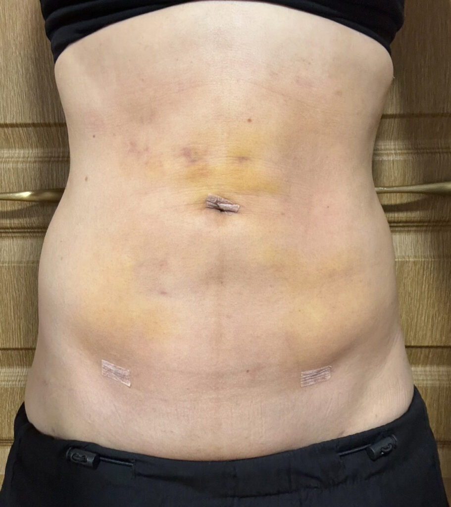 お腹の脂肪吸引