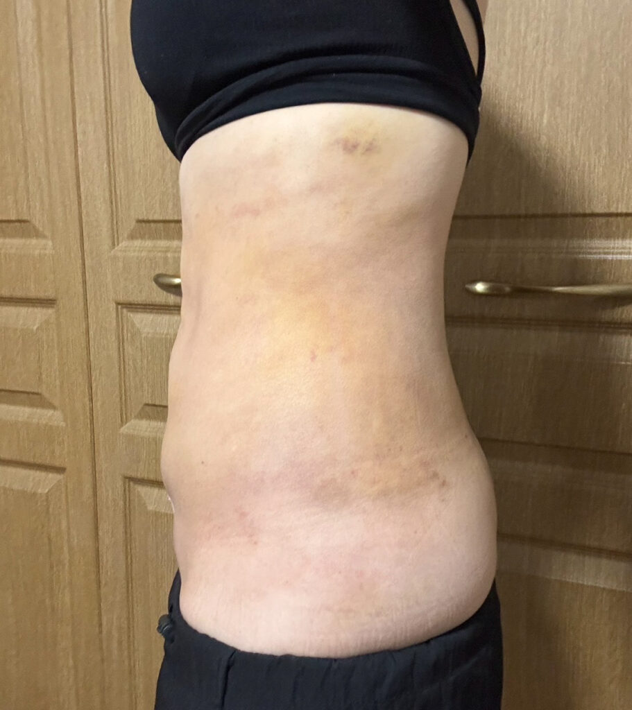 お腹の脂肪吸引