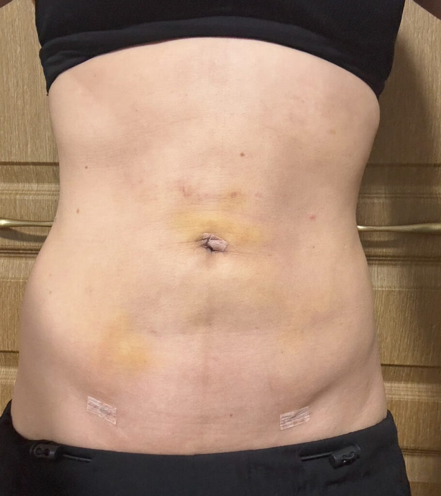 お腹の脂肪吸引