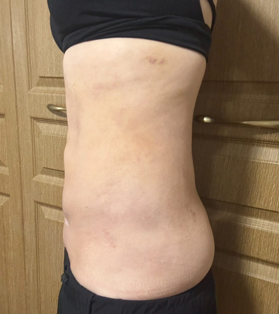 お腹の脂肪吸引