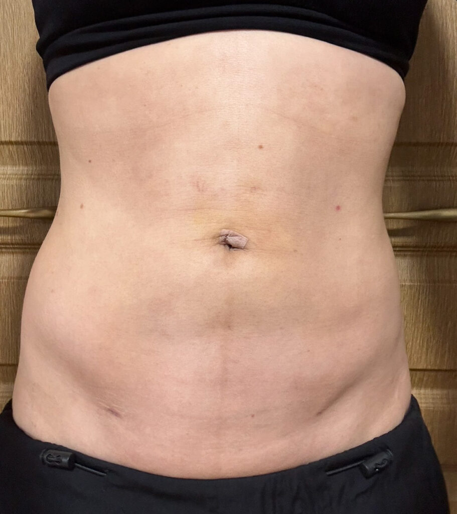 お腹の脂肪吸引