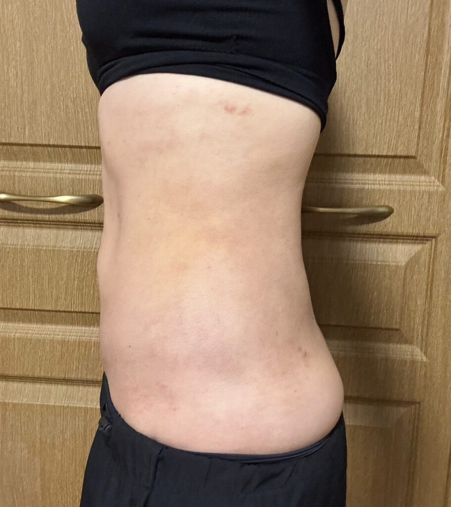 お腹の脂肪吸引