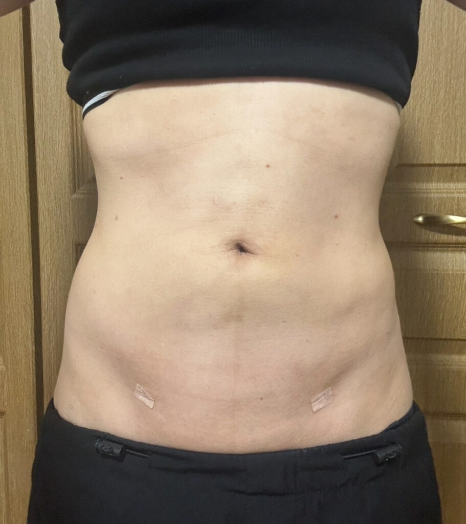 お腹の脂肪吸引