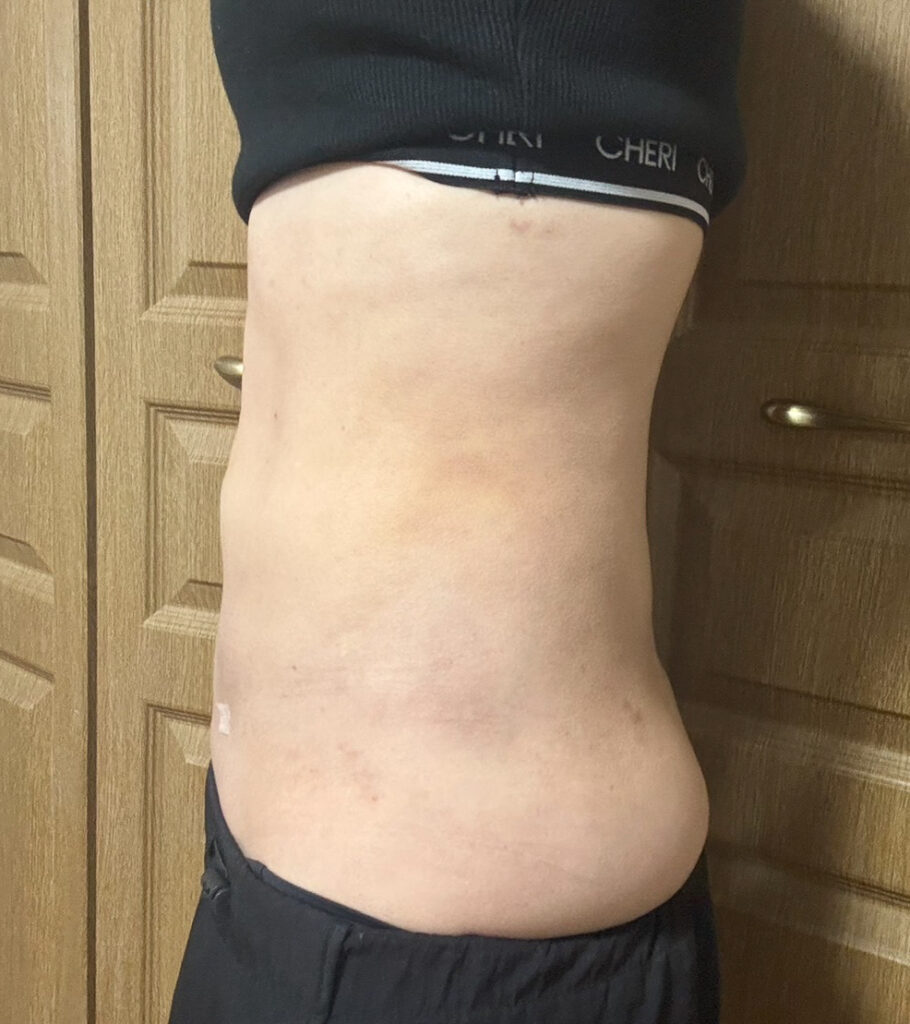 お腹の脂肪吸引