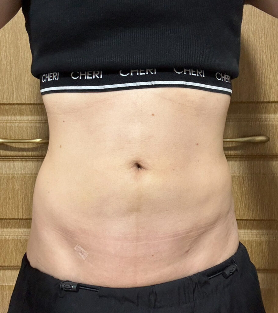 お腹の脂肪吸引