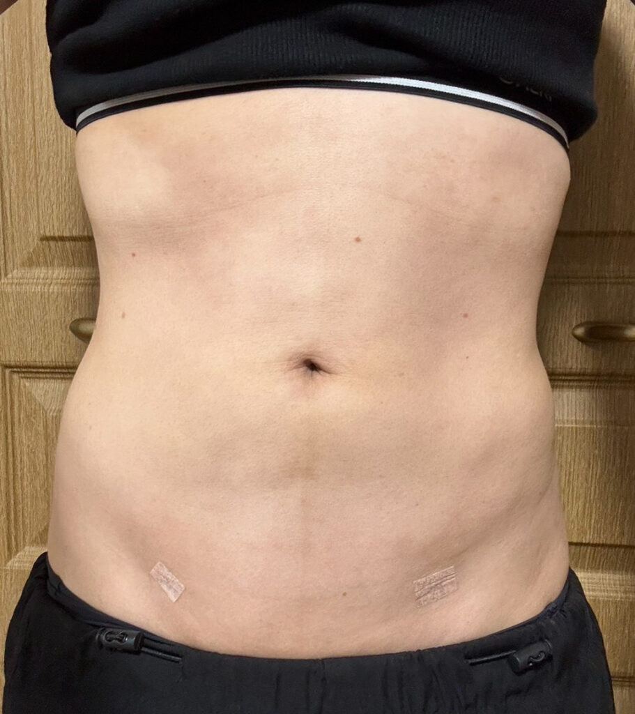 お腹の脂肪吸引