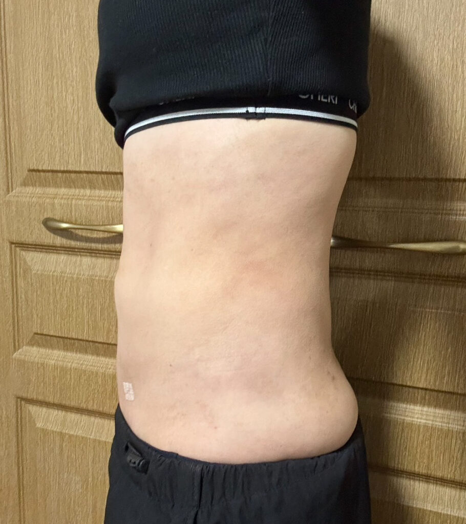 お腹の脂肪吸引
