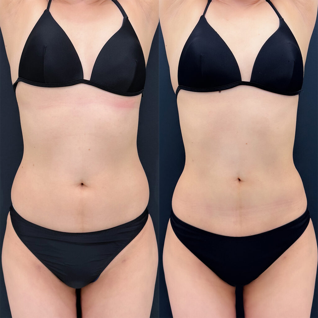 お腹の脂肪吸引