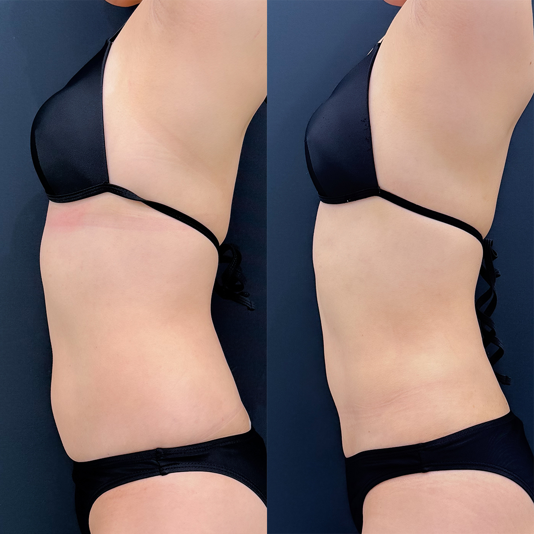 https://purelys-tokyo-clinic.com/wp/wp-content/uploads/2026/03/Before-and-After-abdominal-Liposuction_Case-No.248.jpg