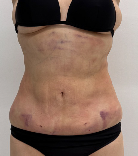 お腹の脂肪吸引