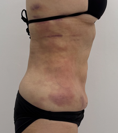 お腹の脂肪吸引