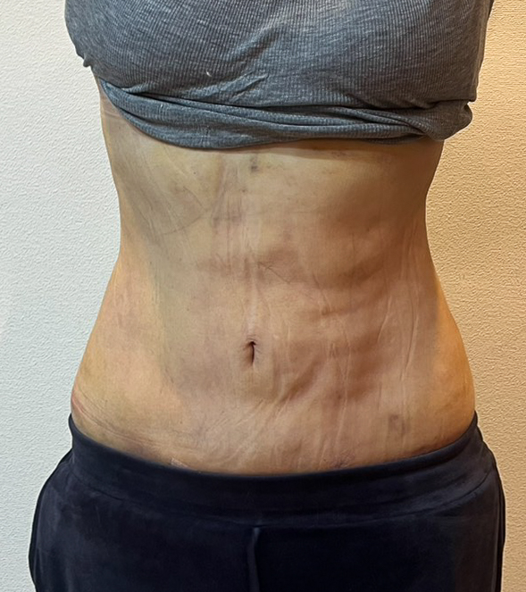 お腹の脂肪吸引
