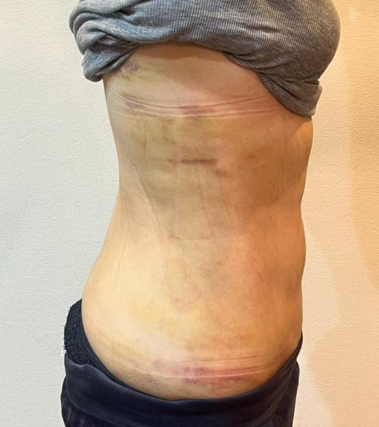 お腹の脂肪吸引