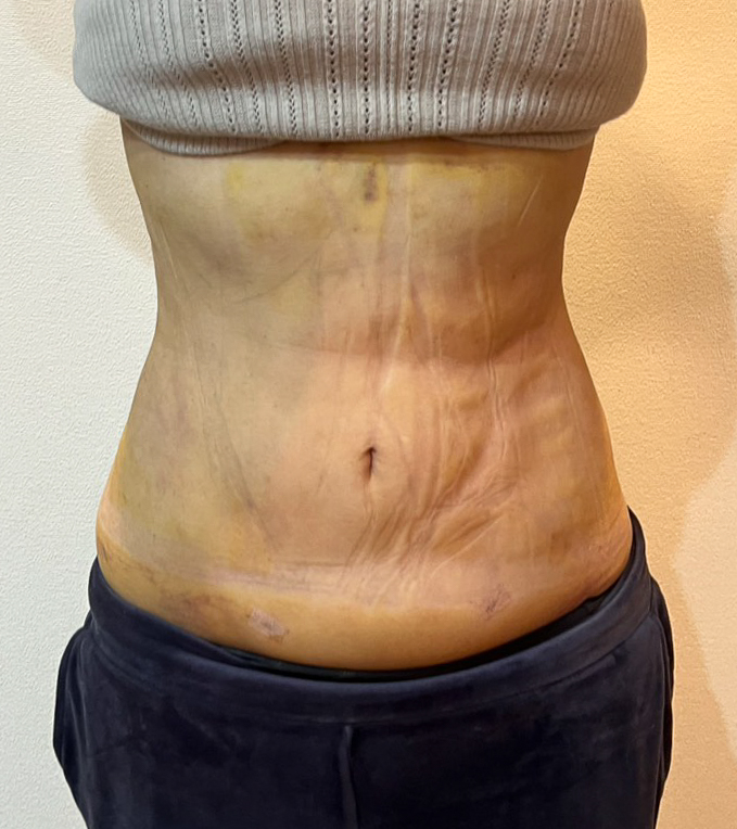 お腹の脂肪吸引