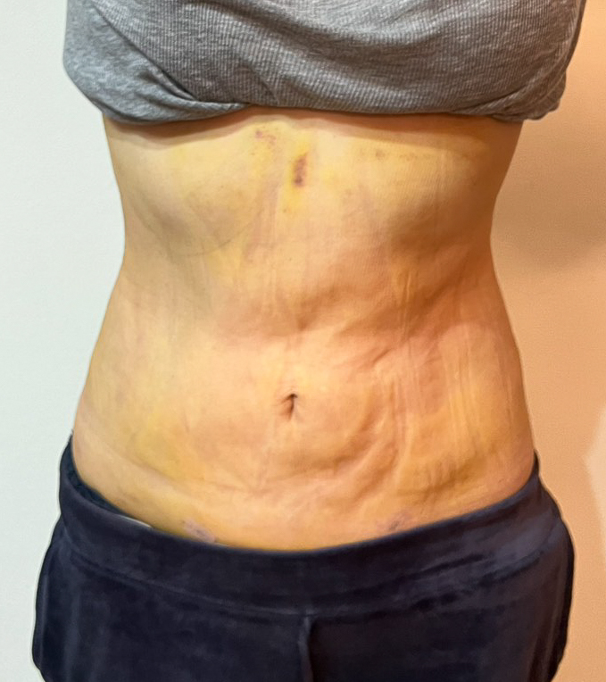 お腹の脂肪吸引