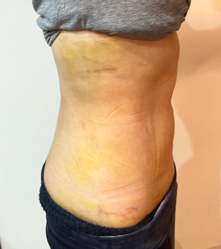 お腹の脂肪吸引