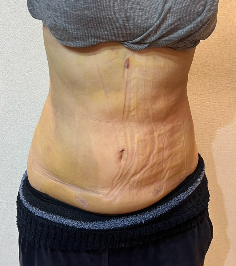 お腹の脂肪吸引