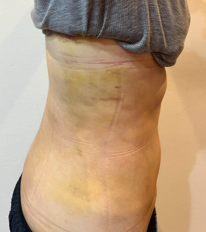 お腹の脂肪吸引