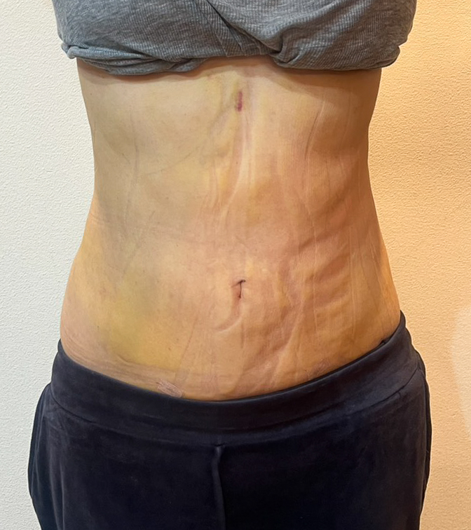 お腹の脂肪吸引