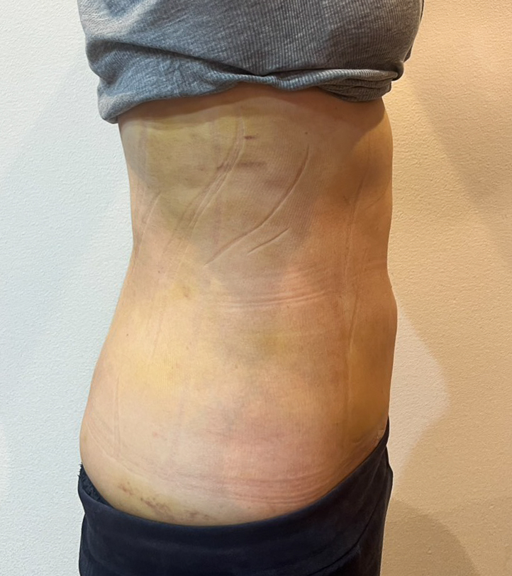 お腹の脂肪吸引