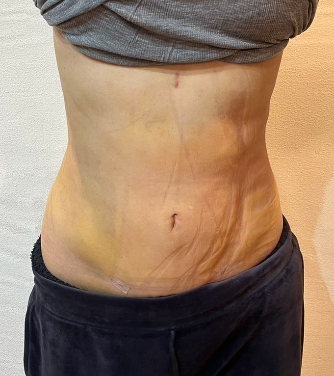 お腹の脂肪吸引