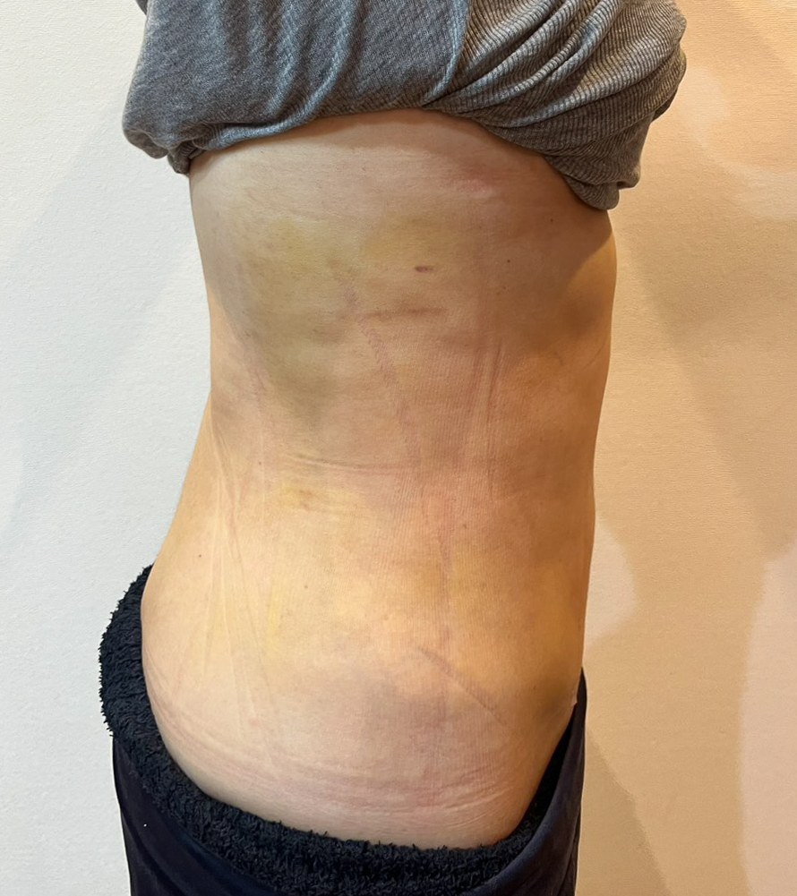 お腹の脂肪吸引