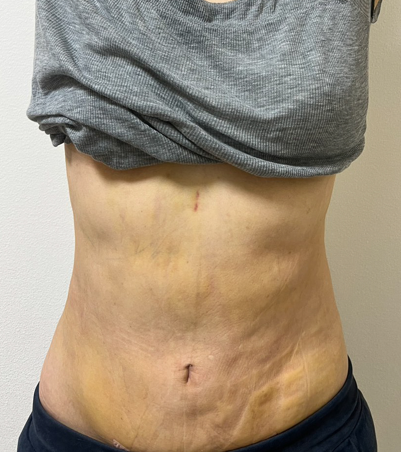 お腹の脂肪吸引