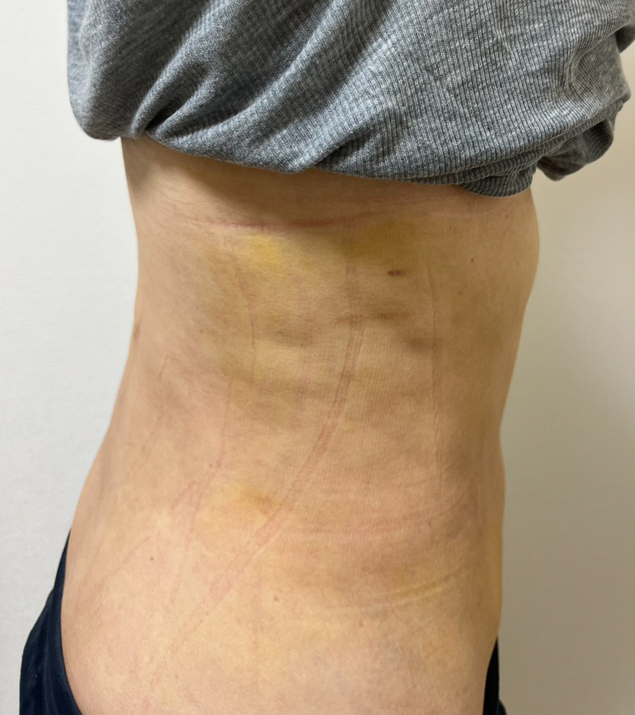 お腹の脂肪吸引