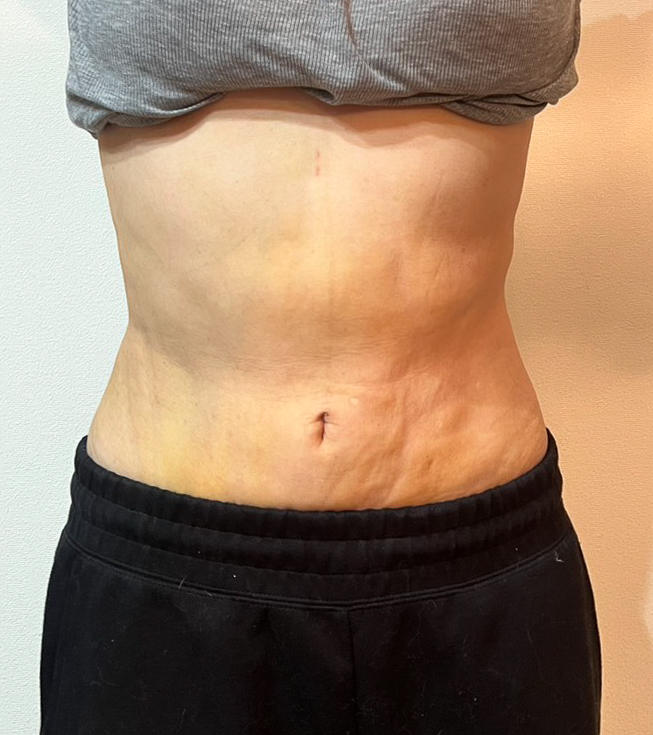 お腹の脂肪吸引