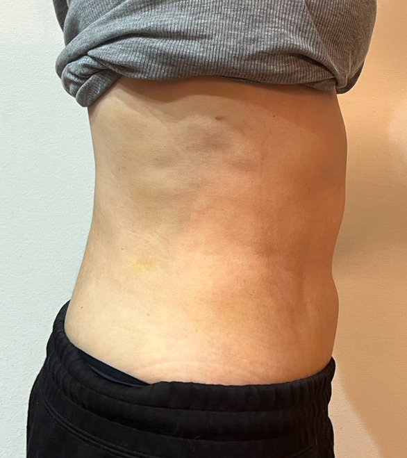 お腹の脂肪吸引